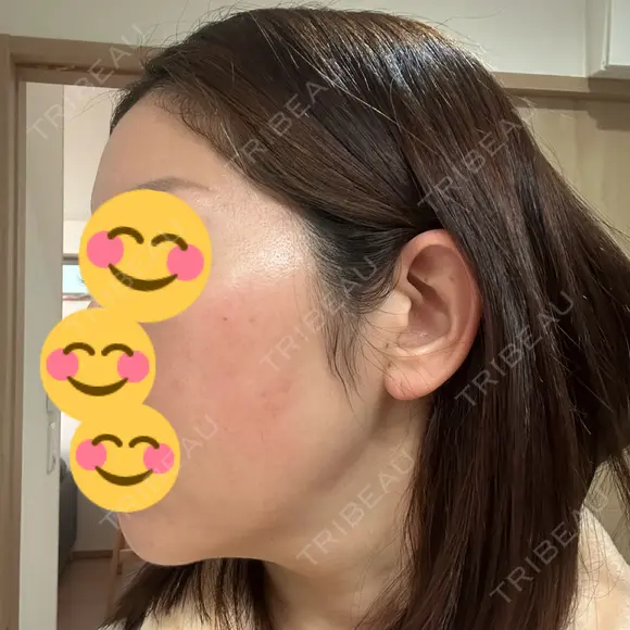 インモード Moon Beauty Clinic DAY 6 メイン用