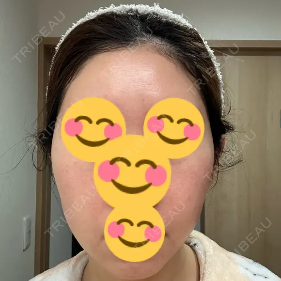 インモード Moon Beauty Clinic DAY 7 メイン用