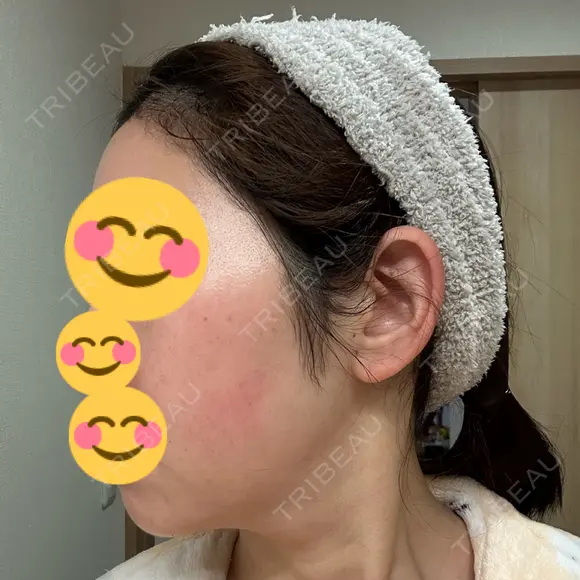 インモード Moon Beauty Clinic DAY 7 メイン用