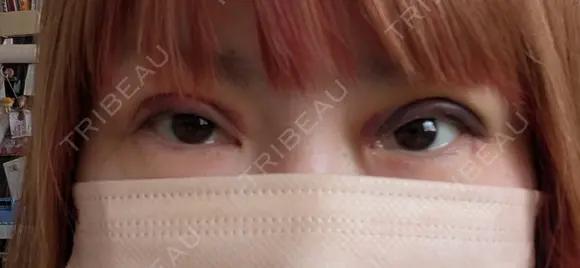 二重埋没 湘南美容クリニック 千葉センシティ院 DAY 5 メイン用