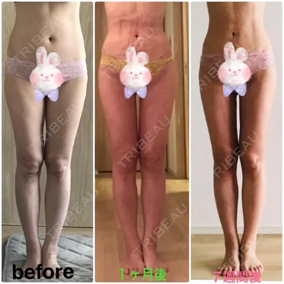 脂肪吸引（脚） / 脂肪吸引（お腹） / 脂肪吸引（お尻） ラインカルチャークリニック DAY 50 メイン用