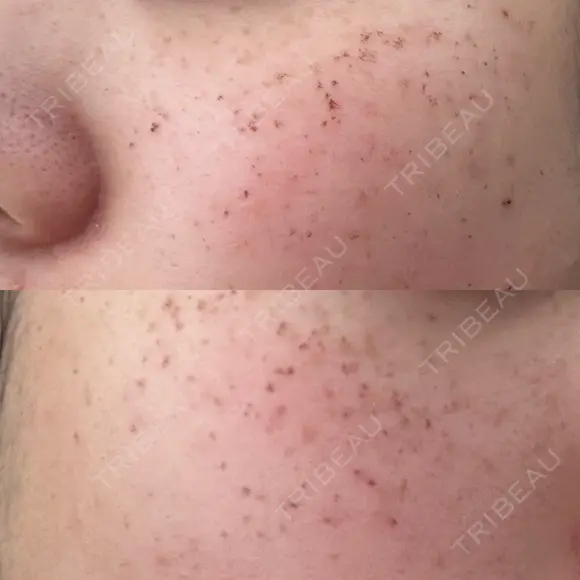 ピーリング（ニキビ・毛穴） / イオン導入 / ルメッカ ルラ美容クリニック 札幌本院 DAY 3 メイン用