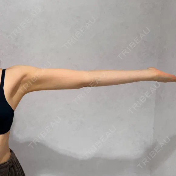 脂肪吸引（脚） / 脂肪吸引（腰） / 脂肪吸引（背中） / 脂肪吸引（肩） アリエル美容クリニック 横浜院 DAY 202 メイン用