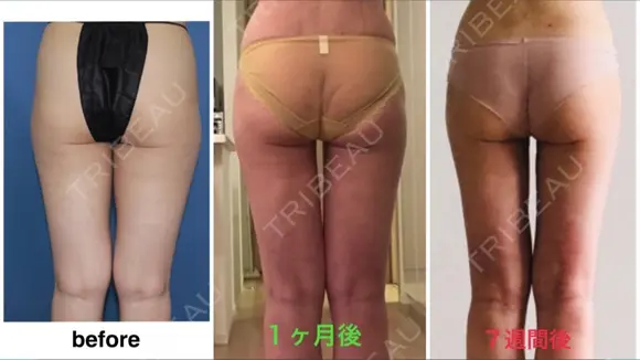脂肪吸引（脚） / 脂肪吸引（お腹） / 脂肪吸引（お尻） ラインカルチャークリニック DAY 50 メイン用