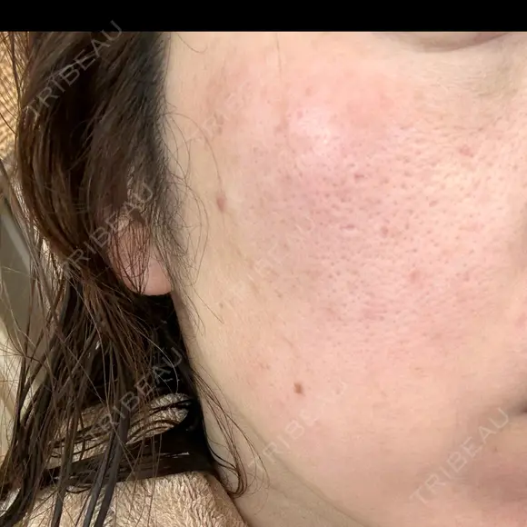 ピーリング（ニキビ・毛穴） / LDM・インテンスウルトラ ライズワン美容皮膚科クリニック DAY 3 メイン用