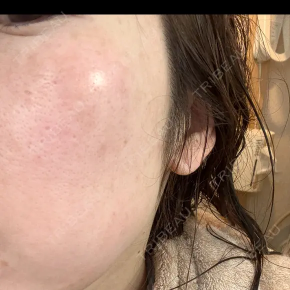 ピーリング（ニキビ・毛穴） / LDM・インテンスウルトラ ライズワン美容皮膚科クリニック DAY 3 メイン用