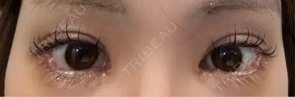 目尻切開 / タレ目形成・グラマラスライン（埋没） LOUIS CLINIC 二子玉川院【ルイクリニック】 DAY 3 メイン用