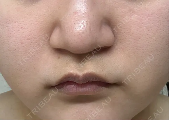 脂肪溶解注射（顔） ミニマムスキンクリニック池袋 AFTER メイン用