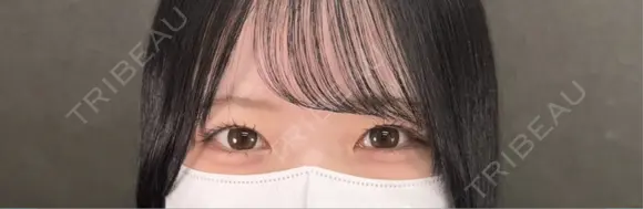 二重埋没 ネビュラクリニック 京都院 AFTER メイン用