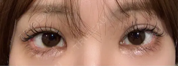 目尻切開 / タレ目形成・グラマラスライン（埋没） LOUIS CLINIC 二子玉川院【ルイクリニック】 DAY 4 メイン用