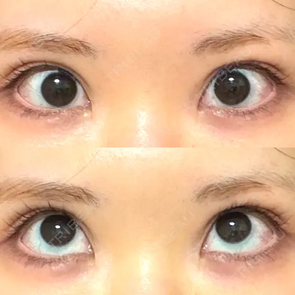 タレ目形成・グラマラスライン（切開） 形成外科と美容外科のクリニック池袋 DAY 46 メイン用