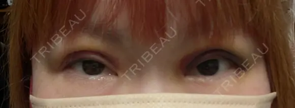 二重埋没 湘南美容クリニック 千葉センシティ院 DAY 6 メイン用