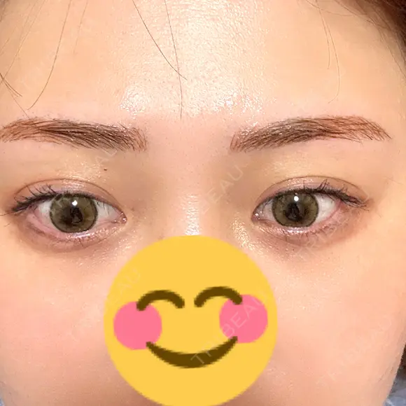 アートメイク（眉） G MEDICAL ART クリニック 新宿院 AFTER メイン用