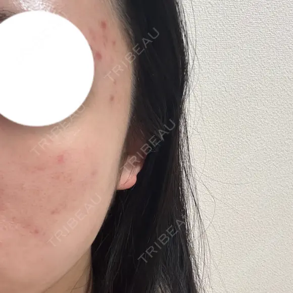 ミラノリピール ゆう美容クリニック DAY 1 メイン用