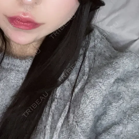 ボトックス（あご） / ヒアルロン酸注入（あご） / ヒアルロン酸注入（唇） HAAB×DREAM BEAUTY CLINIC 大阪梅田院 DAY 5 メイン用