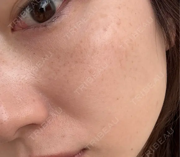 ピーリング（ハリ・ツヤ） / ルメッカ L‘amour clinic Tokyo【ラムールクリニック東京】 DAY 1 メイン用