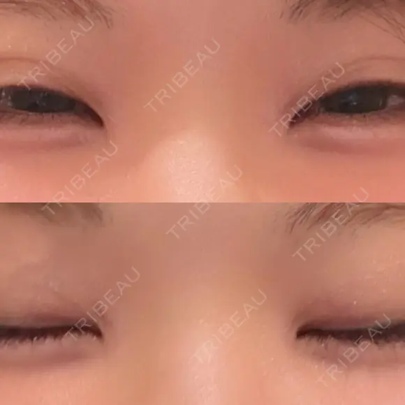 二重埋没 / 目頭切開 THE FIRST CLINIC 多摩センター院 AFTER メイン用