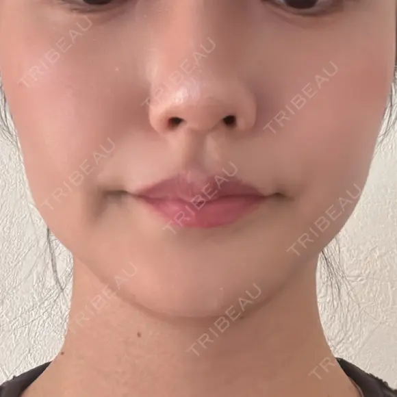 ボトックス（エラ・小顔） 新未来クリニック AFTER メイン用