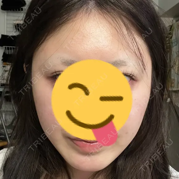 糸リフト A CLINIC（エークリニック） 大阪院 DAY 4 メイン用