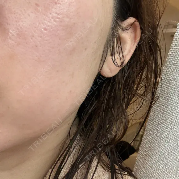 ピーリング（ニキビ・毛穴） / LDM・インテンスウルトラ ライズワン美容皮膚科クリニック DAY 4 メイン用