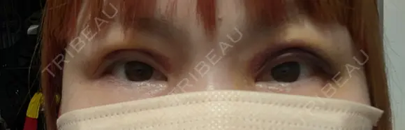 二重埋没 湘南美容クリニック 千葉センシティ院 DAY 7 メイン用