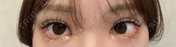 目尻切開 / タレ目形成・グラマラスライン（埋没） LOUIS CLINIC 二子玉川院【ルイクリニック】 DAY 5 メイン用