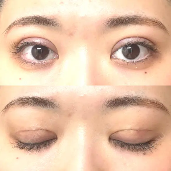 二重切開 EMMA CLINIC（エマクリニック） DAY 19 メイン用