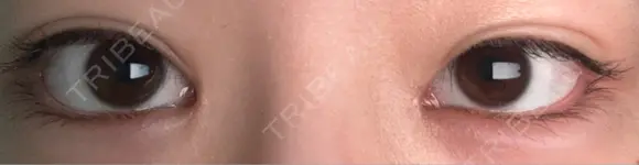 ヒアルロン酸注入（涙袋） 吉祥寺アイビークリニック DAY 24 メイン用