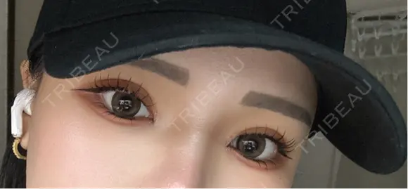 二重埋没 / 目頭切開 東京シンデレラ美容外科 池袋院 DAY 10 メイン用