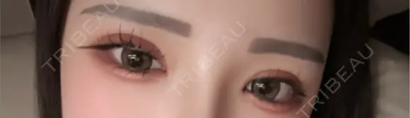 二重埋没 / 目頭切開 東京シンデレラ美容外科 池袋院 AFTER メイン用