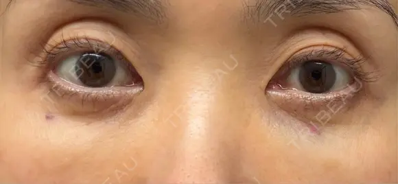 スネコス 札幌美容外科ネビュラクリニック DAY 1 メイン用