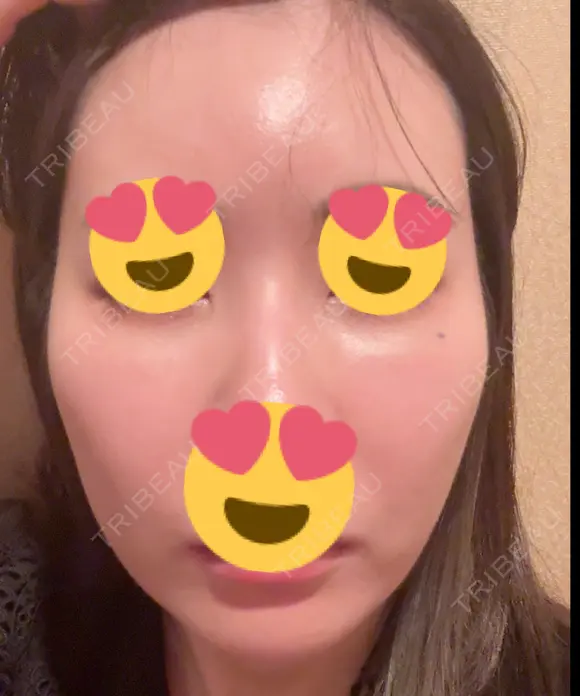 毛穴洗浄（ハイドラフェイシャルなど） / ピコレーザートーニング（美白・肝斑） 表参道ウィズ・クリニック DAY 2 メイン用