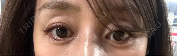 ヒアルロン酸注入（涙袋） eクリニック 大阪院 AFTER メイン用