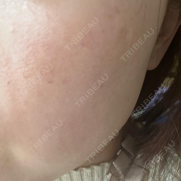 光治療（フォトフェイシャルなど） BITO BEAUTY CLINIC DAY 0 メイン用
