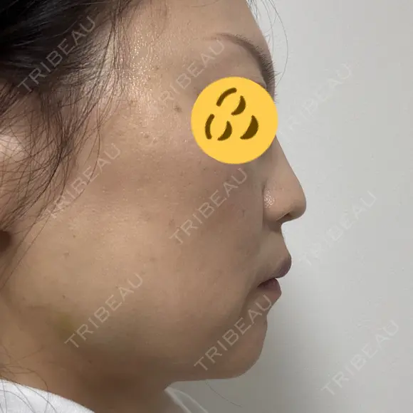 ボトックス（エラ・小顔） TCB東京中央美容外科 神戸院 DAY 9 メイン用