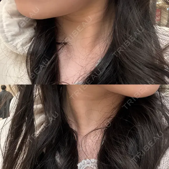 ボトックス（エラ・小顔） / ボトックス（肩） Tokyo Tensei Clinic 新宿院 AFTER メイン用