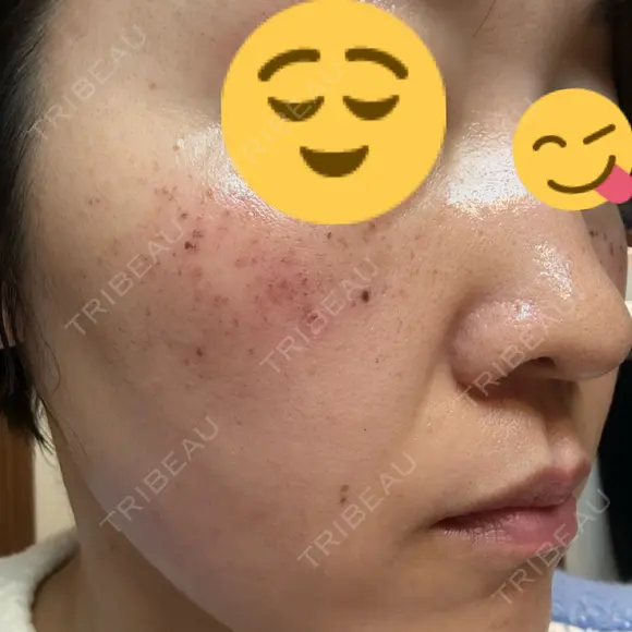イオン導入 / ピーリング（ハリ・ツヤ） / ルメッカ ルラ美容クリニック 千葉院 / ルラスキンクリニック 千葉院 DAY 0 メイン用