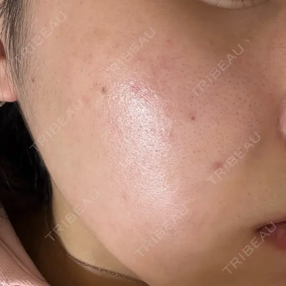 ピーリング（ニキビ・毛穴） / フラクショナルレーザー（毛穴・ニキビ跡） RIN BEAUTY CLINIC DAY 0 メイン用