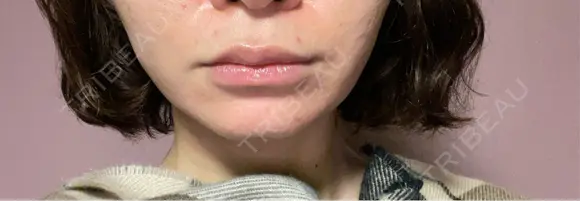 ボトックス（エラ・小顔） ルラ美容クリニック 郡山院 DAY 0 メイン用