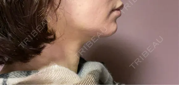 ボトックス（エラ・小顔） ルラ美容クリニック 郡山院 DAY 0 メイン用