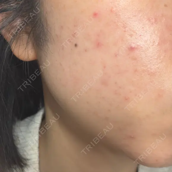 毛穴洗浄（ハイドラフェイシャルなど） / ルメッカ おおかみ美容のクリニック 新宿院 DAY 0 メイン用