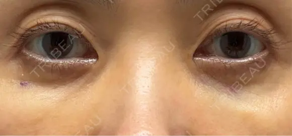 スネコス 札幌美容外科ネビュラクリニック DAY 2 メイン用