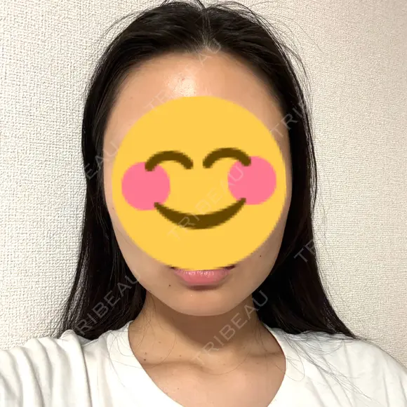 糸リフト / 脂肪吸引（顔） EMMA CLINIC（エマクリニック） DAY 16 メイン用