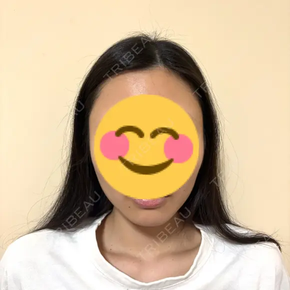 糸リフト / 脂肪吸引（顔） EMMA CLINIC（エマクリニック） AFTER メイン用