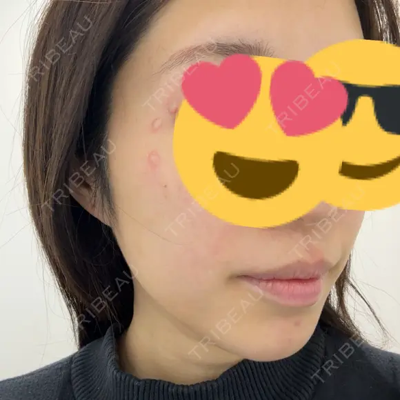 ピコレーザートーニング（美白・肝斑） / ピコスポット APスキンクリニック銀座 AFTER メイン用