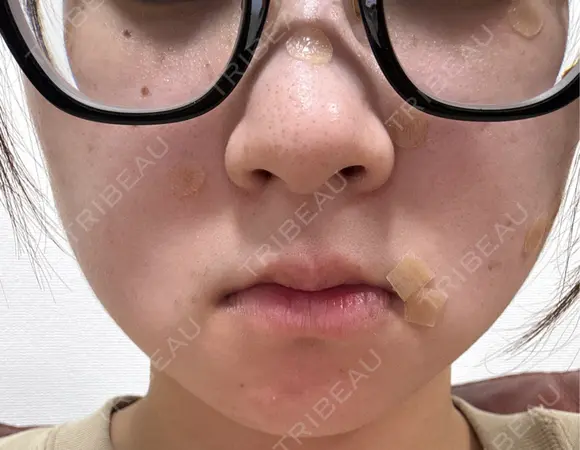 ほくろ・いぼ除去レーザー（肌） Fellez Clinic【フェルズクリニック】 DAY 0 メイン用
