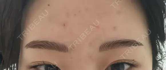 アートメイク（眉） G MEDICAL ART クリニック 新宿院 DAY 1 メイン用