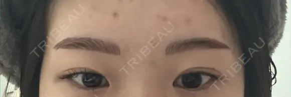 アートメイク（眉） G MEDICAL ART クリニック 新宿院 DAY 2 メイン用