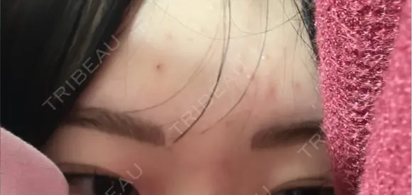 アートメイク（眉） G MEDICAL ART クリニック 新宿院 DAY 3 メイン用