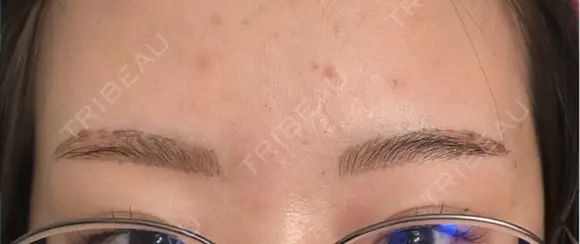 アートメイク（眉） G MEDICAL ART クリニック 新宿院 DAY 5 メイン用